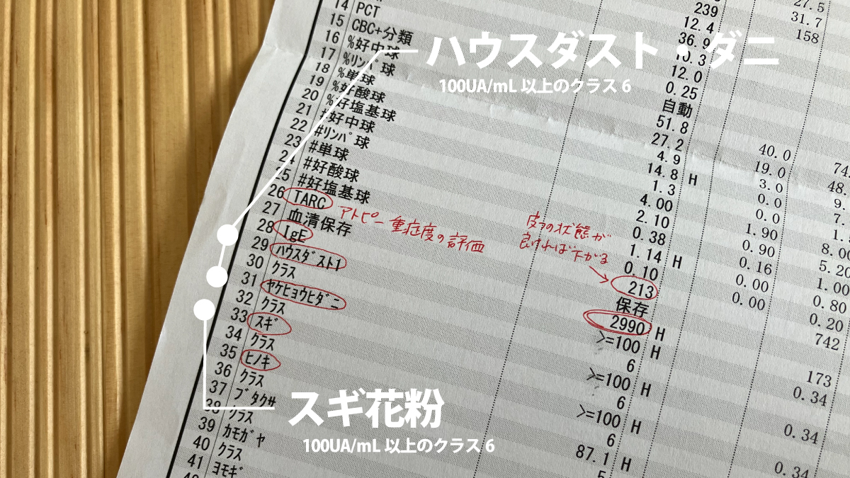 アレルギー検査の結果（ハウスダスト・ダニ・スギ花粉が100以上のクラス6）